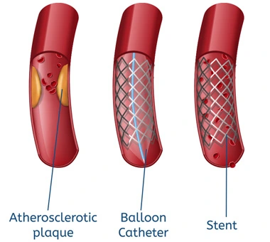 Angioplasty