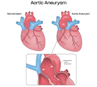 AroticAneurysm