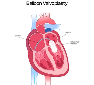 BalloonVolvoplasty