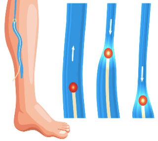 Endovenous Laser Ablation Procedure