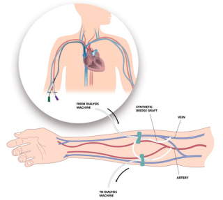 PICC Line