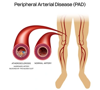 PeripheralArterialDisease