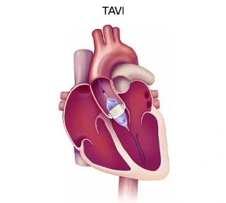 TAVIProcedure