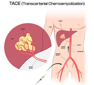 TaceProcedure