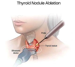 ThyroidNoduleAblation