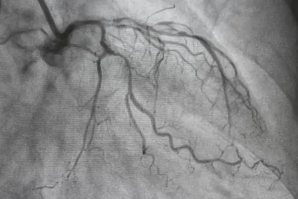 angiography-MICSCABGSurgery