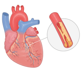 Chronic Angina