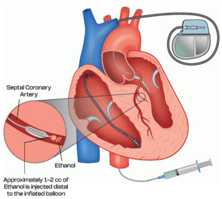 Hcm Ablation