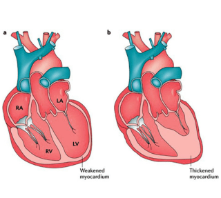 Heart Failure