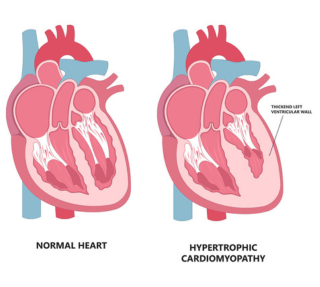 Hypertrophic Cardiomyopathy Hcm