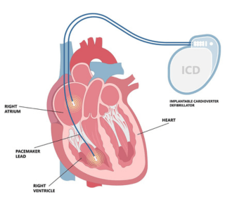 Icd Implantation