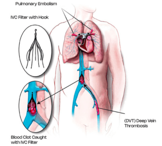 Ivc Filter