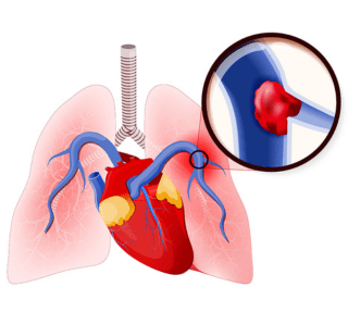 Pulmonary Ebmolisation New