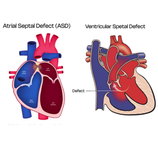 Septaldefectasdvsd