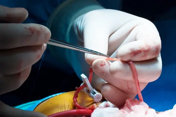 typesofgraft-cabgsurgery